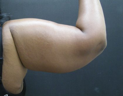 Arm Lift Before & After Patient #10813