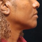 Scarless Facelift and Necklift Before & After Patient #11101