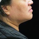 Scarless Facelift and Necklift Before & After Patient #11102