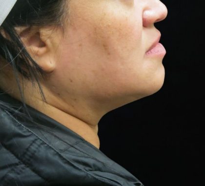 Scarless Facelift and Necklift Before & After Patient #11102