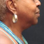 Scarless Facelift and Necklift Before & After Patient #11103