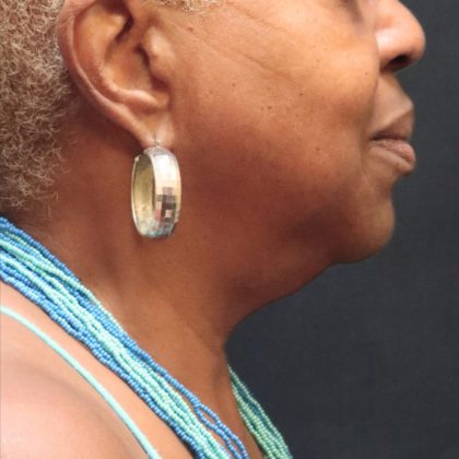 Scarless Facelift and Necklift Before & After Patient #11103