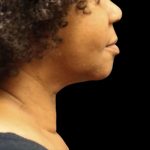 Scarless Facelift and Necklift Before & After Patient #11104
