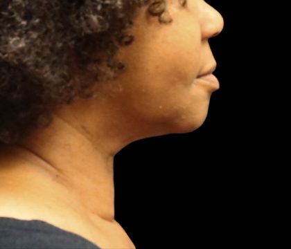 Scarless Facelift and Necklift Before & After Patient #11104