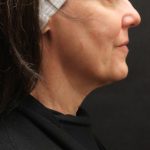 Scarless Facelift and Necklift Before & After Patient #11105