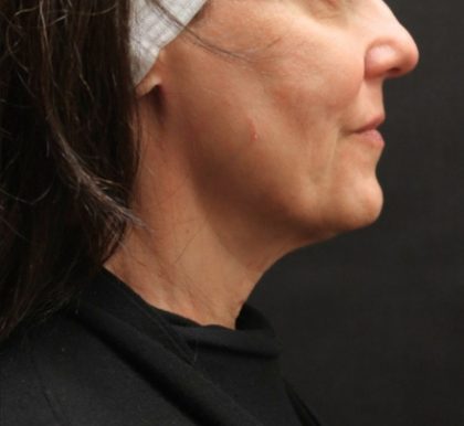 Scarless Facelift and Necklift Before & After Patient #11105