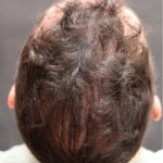 Hair Restoration Before & After Patient #11146