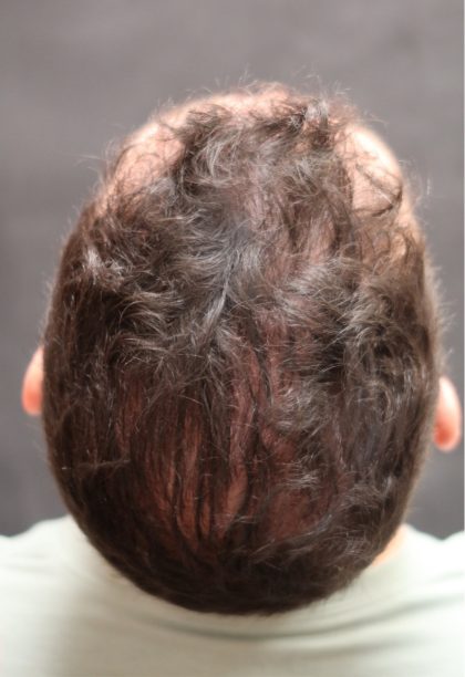 Hair Restoration Before & After Patient #11146