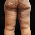 Thigh Lift Before & After Patient #10847