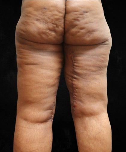 Thigh Lift Before & After Patient #10847