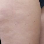 Cellulite Treatment Before & After Patient #10859