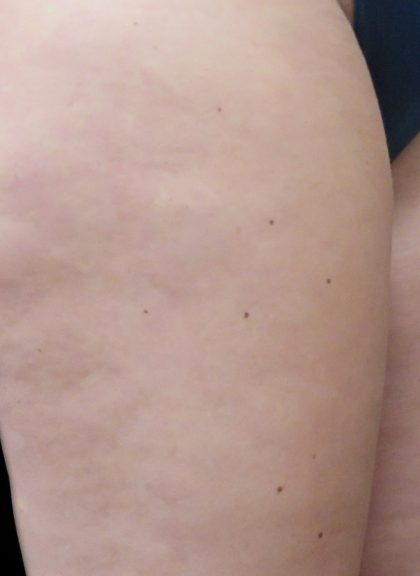 Cellulite Treatment Before & After Patient #10859