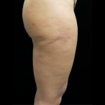 Cellulite Treatment Before & After Patient #10862