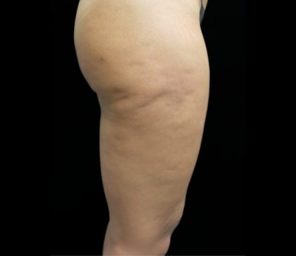 Cellulite Treatment Before & After Patient #10862