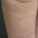Cellulite Treatment Before & After Patient #10863