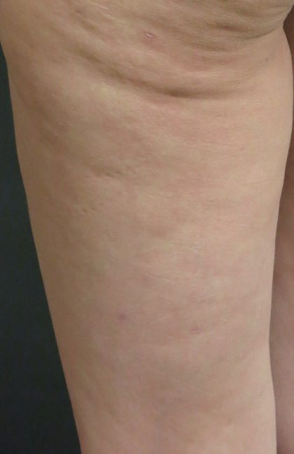 Cellulite Treatment Before & After Patient #10863