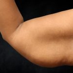 Arm Lift Before & After Patient #10814