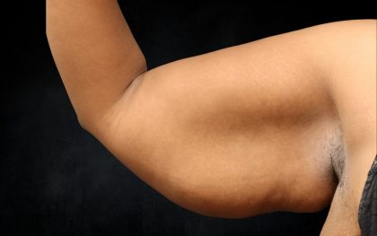 Arm Lift Before & After Patient #10814