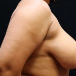 Breast Asymmetry Before & After Patient #10903