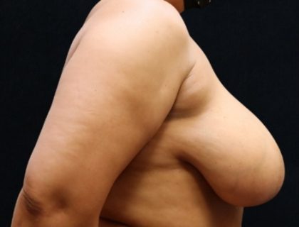 Breast Asymmetry Before & After Patient #10903