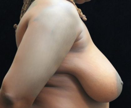 Breast Asymmetry Before & After Patient #10905