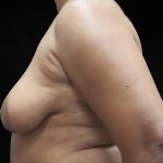Breast Lift Before & After Patient #11045