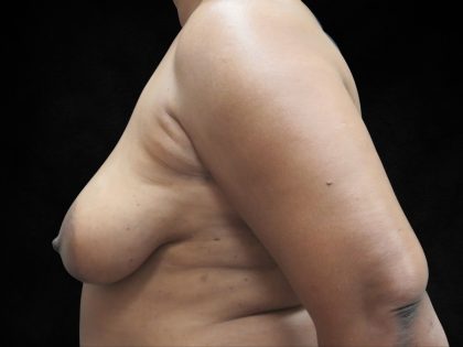 Breast Lift Before & After Patient #11045