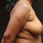 Breast Lift Before & After Patient #11046