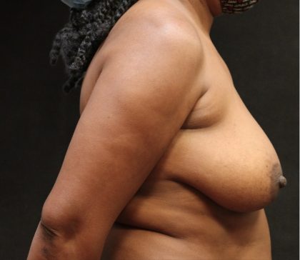 Breast Lift Before & After Patient #11046