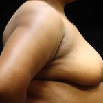 Breast Lift Before & After Patient #11049