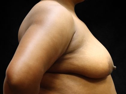 Breast Lift Before & After Patient #11049