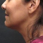 Scarless Facelift and Necklift Before & After Patient #11100