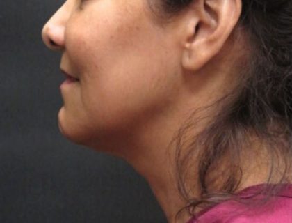 Scarless Facelift and Necklift Before & After Patient #11100