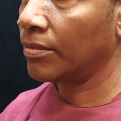 Scarless Facelift and Necklift Before & After Patient #11101