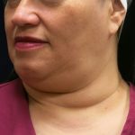 Scarless Facelift and Necklift Before & After Patient #11102