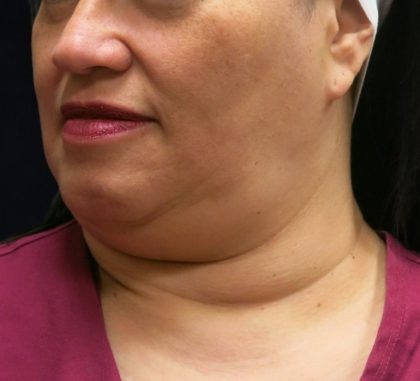 Scarless Facelift and Necklift Before & After Patient #11102