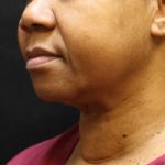 Scarless Facelift and Necklift Before & After Patient #11104