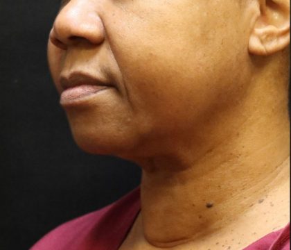 Scarless Facelift and Necklift Before & After Patient #11104
