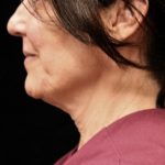 Scarless Facelift and Necklift Before & After Patient #11105
