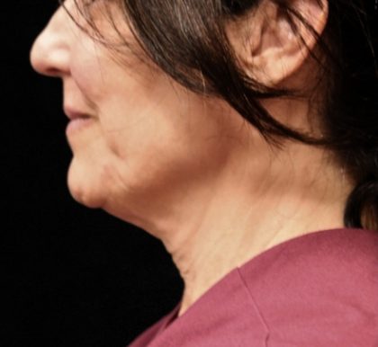 Scarless Facelift and Necklift Before & After Patient #11105