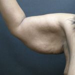 Arm Lift Before & After Patient #10813