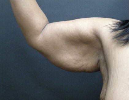 Arm Lift Before & After Patient #10813