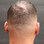 Hair Restoration Before & After Patient #11146