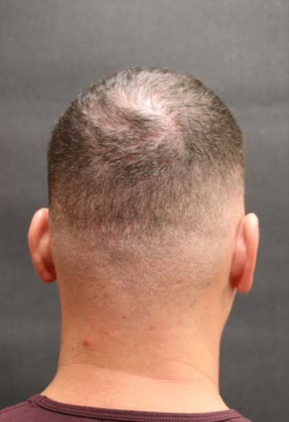 Hair Restoration Before & After Patient #11146