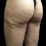 Cellulite Treatment Before & After Patient #10862
