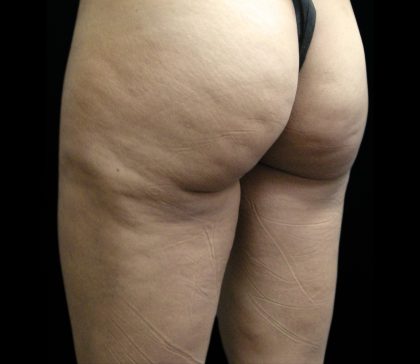 Cellulite Treatment Before & After Patient #10862