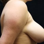 Breast Asymmetry Before & After Patient #10895