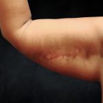 Arm Lift Before & After Patient #10814