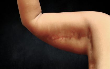 Arm Lift Before & After Patient #10814