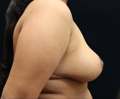 Breast Asymmetry Before & After Patient #10898